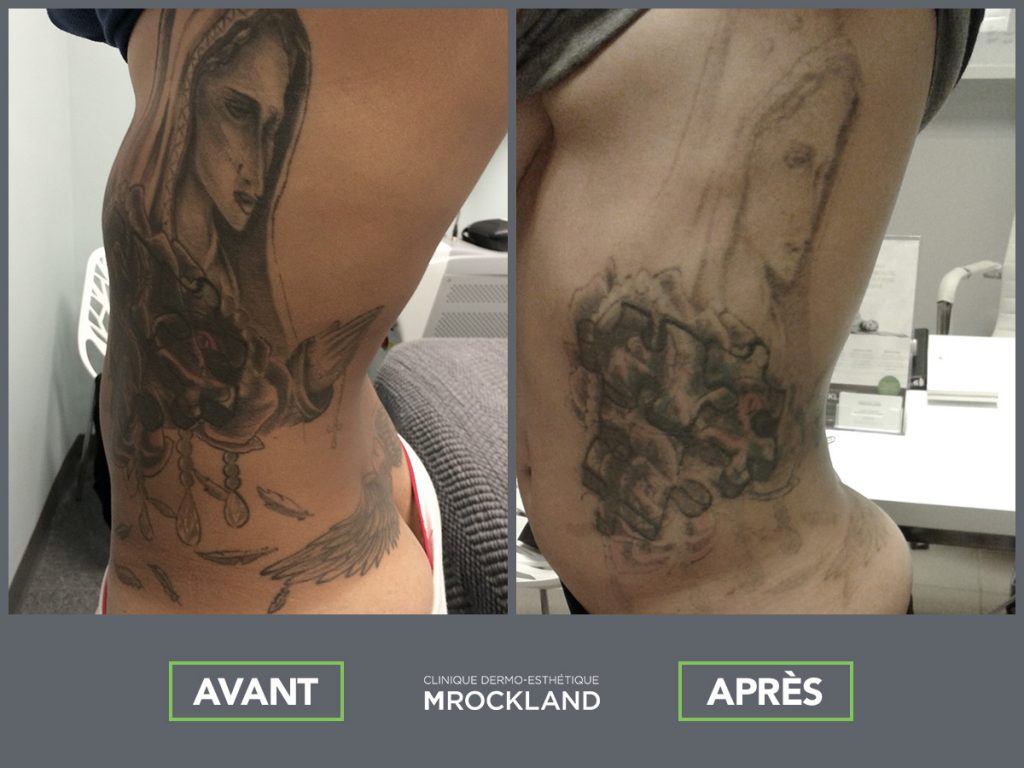 détatouage MRockland